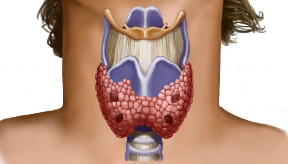 Бетесда 2 щитовидной железы